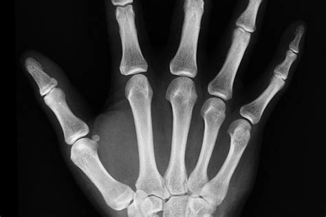 Röntgenový snímok s implantovaným stentom v pažeráku