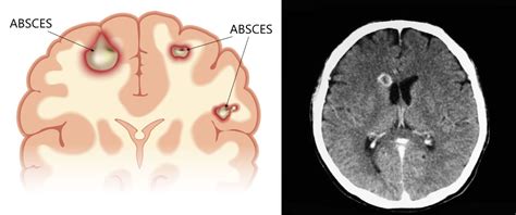 Ilustrácia mozgu s označenými oblasťami poškodenia