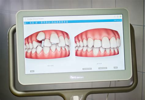 Vizualizácia anomálneho postavenia zubov