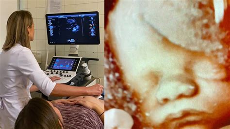 Ultrazvukové vyšetrenie plodu s rázštepom chrbtice