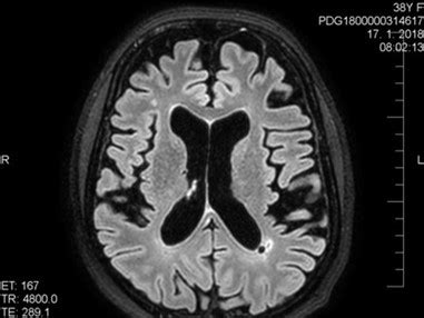 MRI snímka mozgu pacienta so sklerózou multiplex