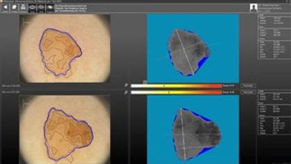 Digitálny dermatoskop pri vyšetrovaní znamienka